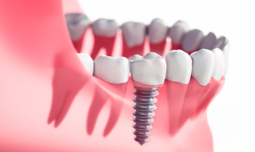 Are Dental Implants in Queen Creek Right for You